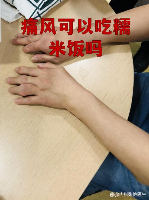 痛风发作能吃糯米吗