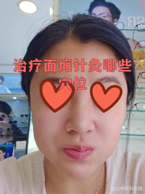 面瘫针灸期间吃什么