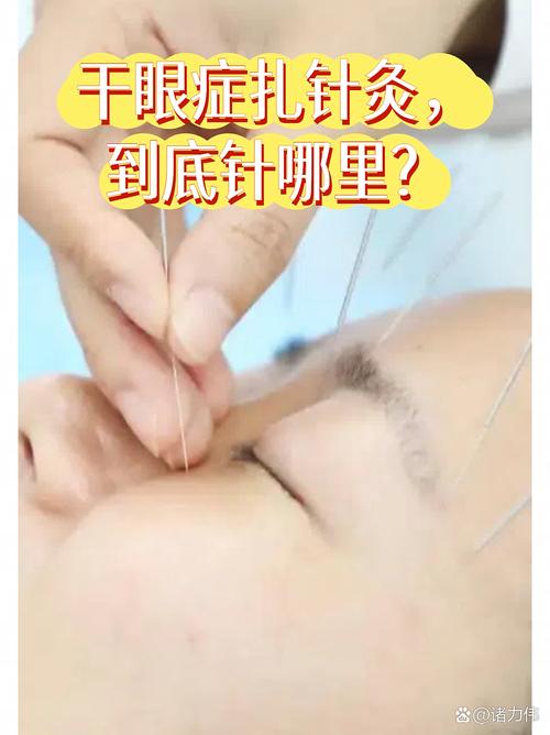 针灸能治好干眼症图