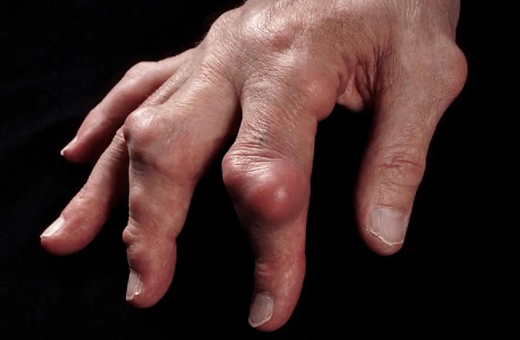 痛风石ct能拍到吗