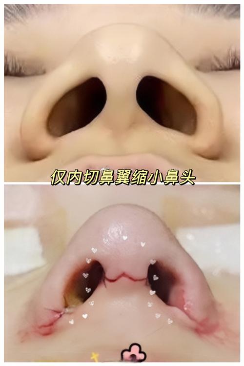 做鼻头缩小手术安全吗