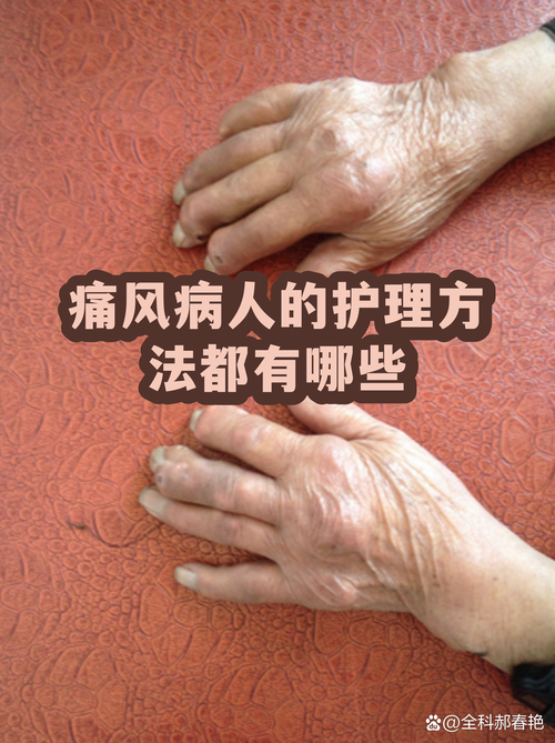 健身对痛风有帮助吗