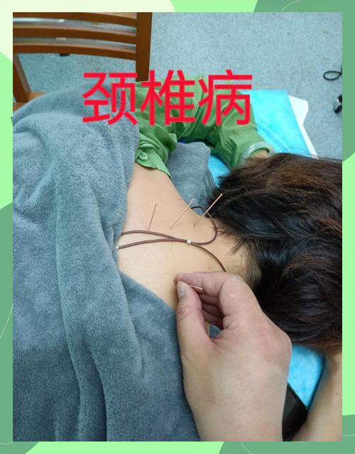 颈椎错位针灸管用吗