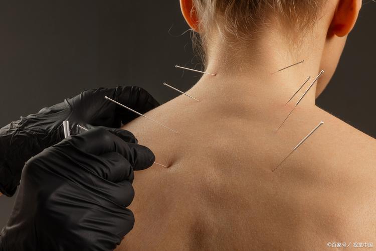 颈椎错位针灸管用吗