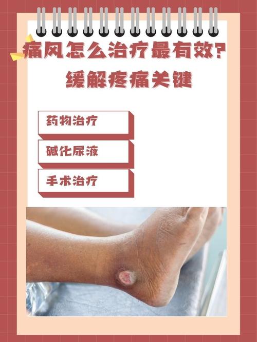 做理疗可以治痛风吗