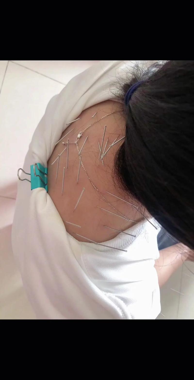 声带麻痹针灸能行吗