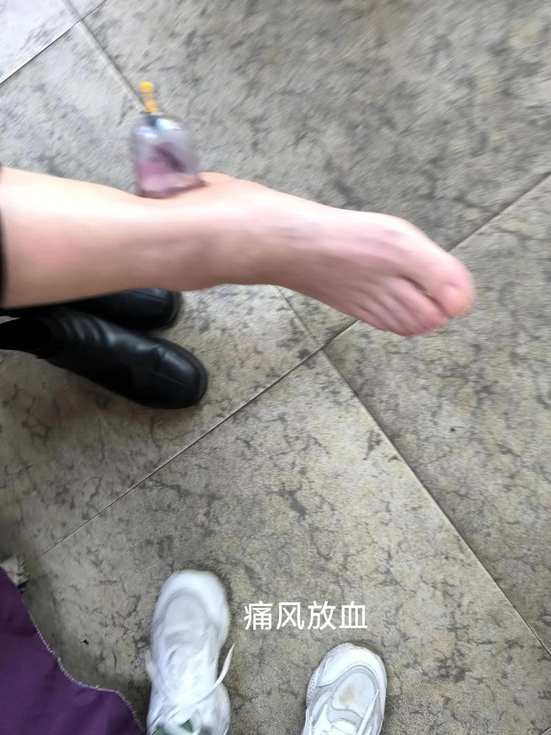 痛风肿的地方有淤血