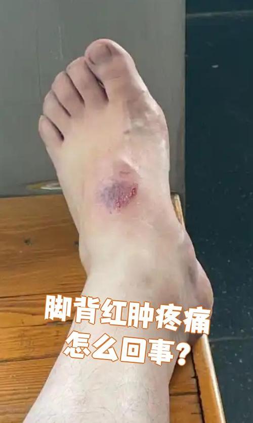 痛风肿的地方有淤血