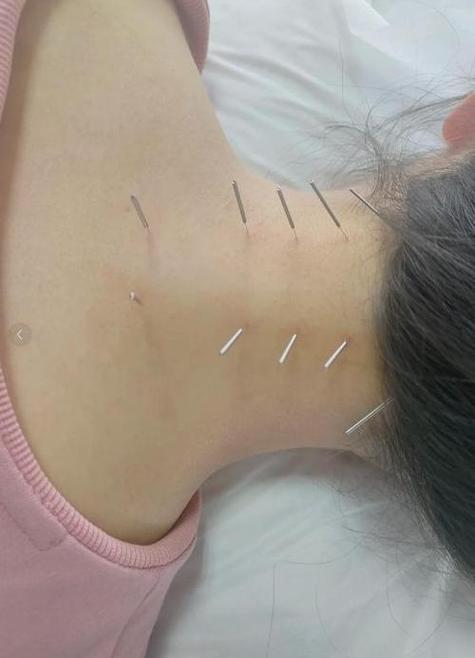 颈椎疼痛可以针灸吗