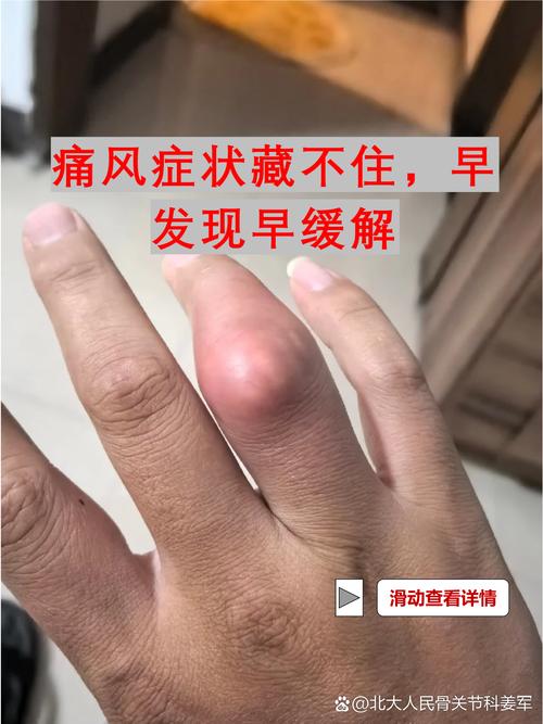 痛风病人容易长肿瘤