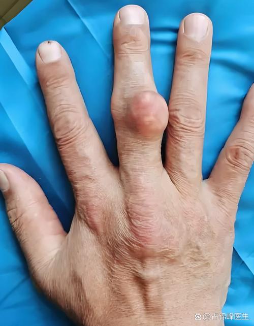 痛风病人容易长肿瘤