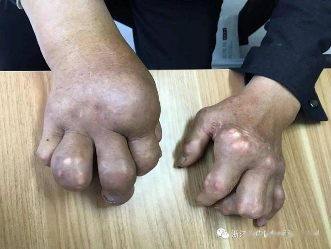 温州杨书生看痛风吗