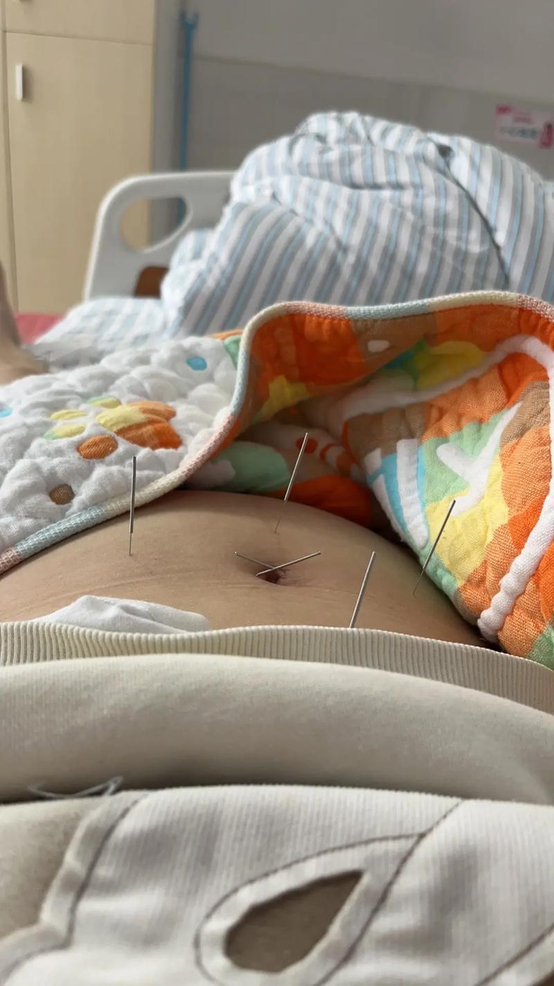 针灸治疗胃病的图片