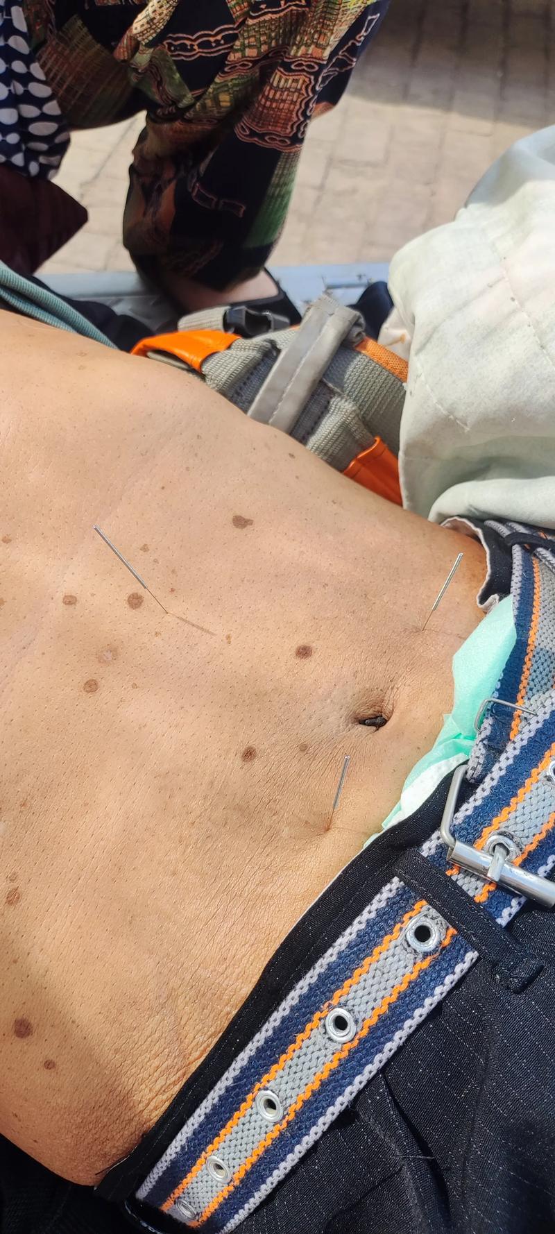 针灸治疗胃病的图片