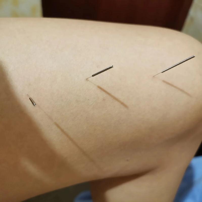 针灸治疗胃病的图片