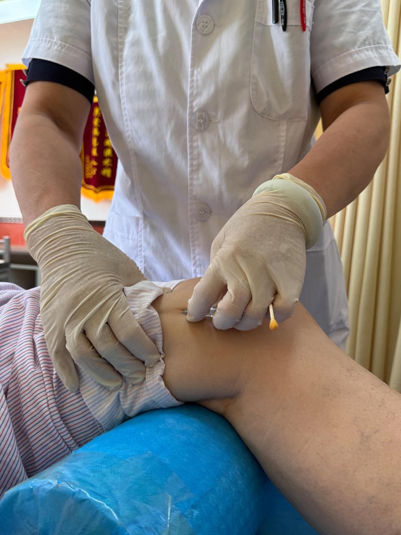 盆腔积液可以针灸吗