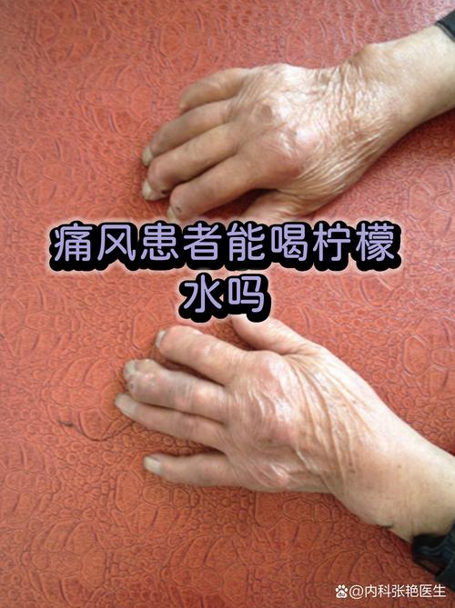 痛风能喝炭酸饮料吗