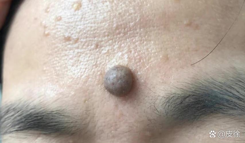 皮内痣是不是最安全的