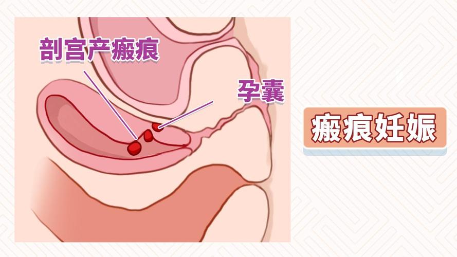 孕囊距切口的安全距离