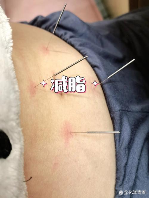 虎门哪里有针灸减肥