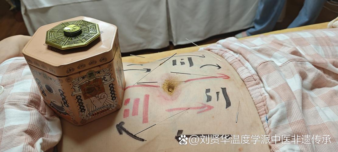 针灸治疗大便不成型