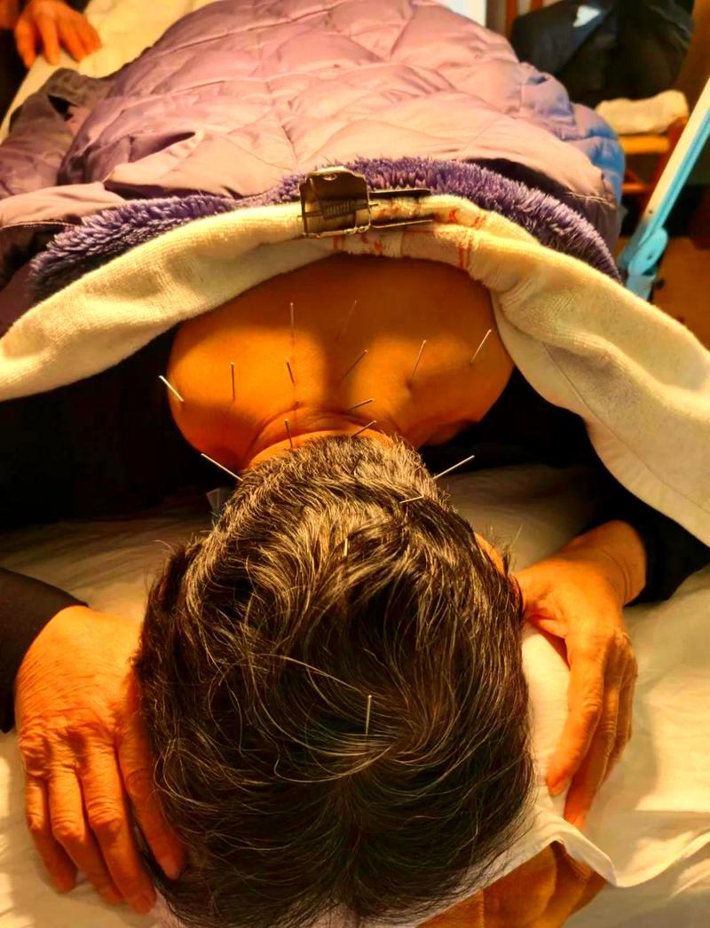 针灸治疗头晕有效吗