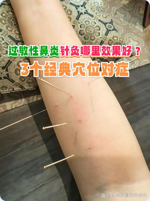 孕妇鼻塞可以针灸吗