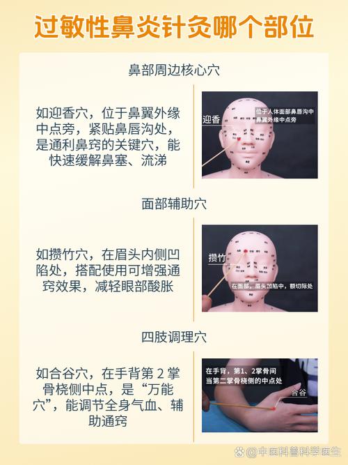 孕妇鼻塞可以针灸吗
