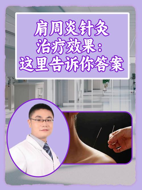 肩周炎针灸几天能好