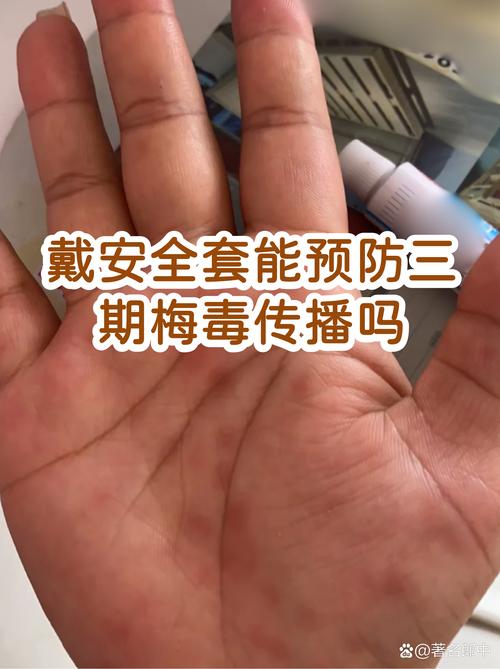 带安全套能预防梅毒吗