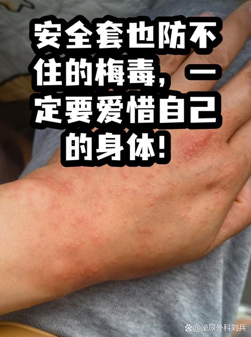 带安全套能预防梅毒吗