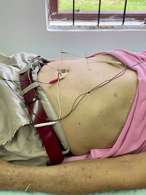 便秘针灸多久有效果