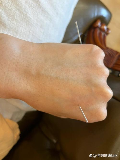 腰疼哪里可以做针灸