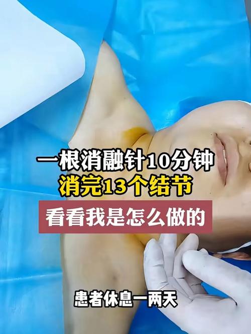 甲状腺结节针灸疗法