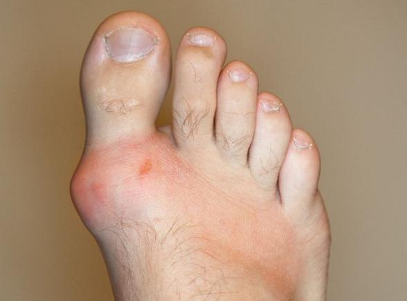 痛风石严重会截肢吗