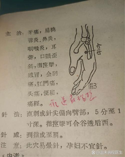 针灸虎口有什么作用