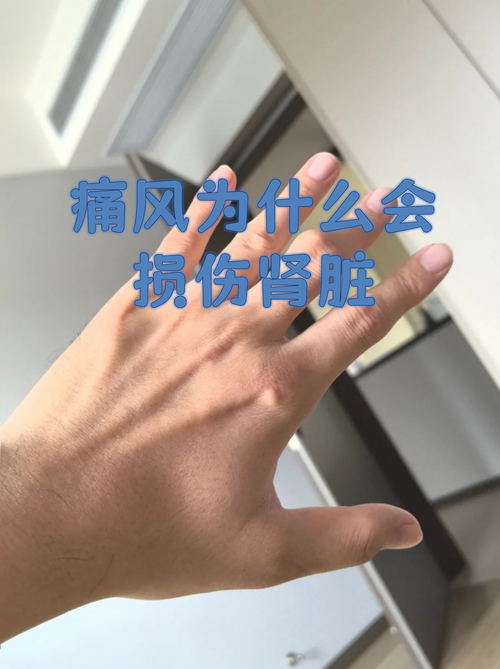 痛风和血栓有关系吗