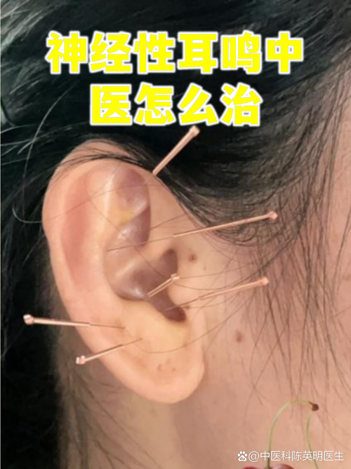 针灸治耳鸣多久见效