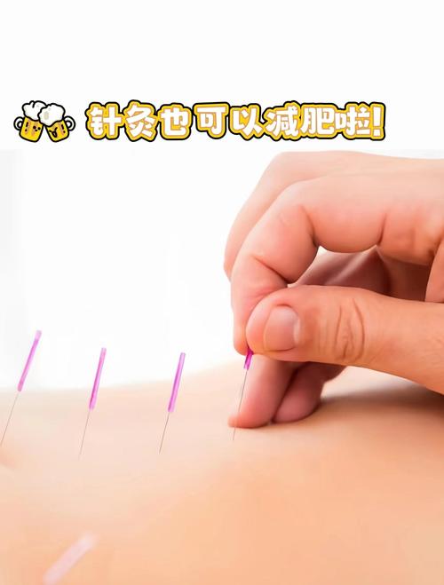 怀孕能做针灸减肥吗