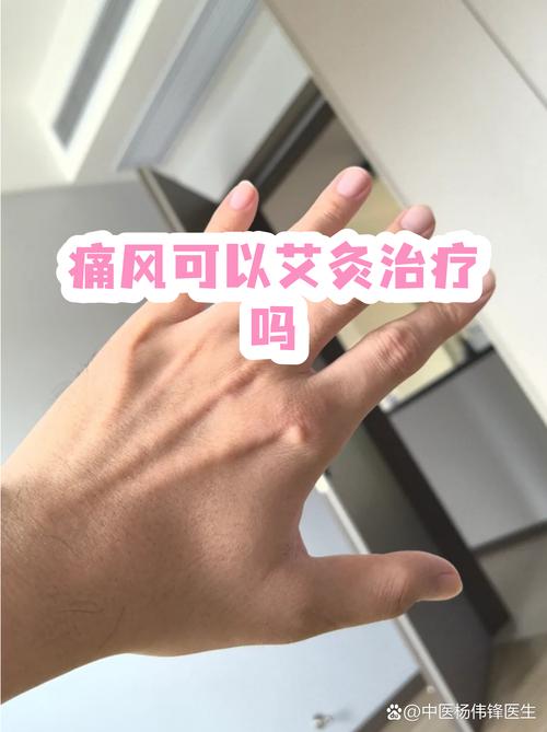 痛风能否用艾灸治疗