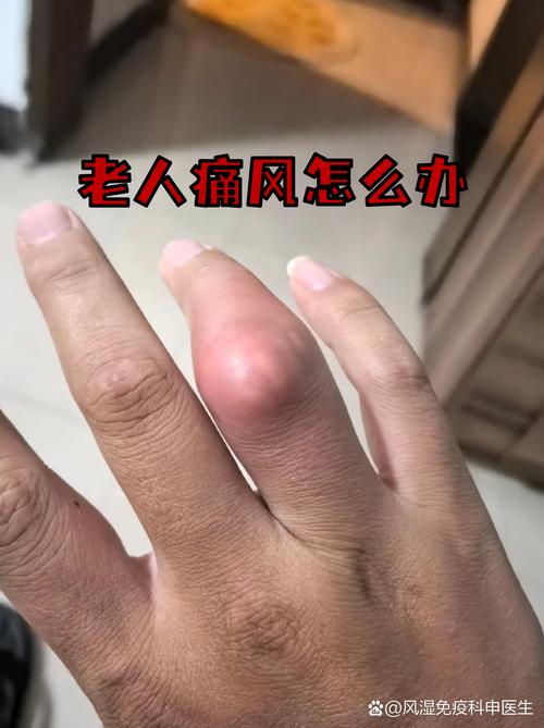 老人得了痛风怎么办