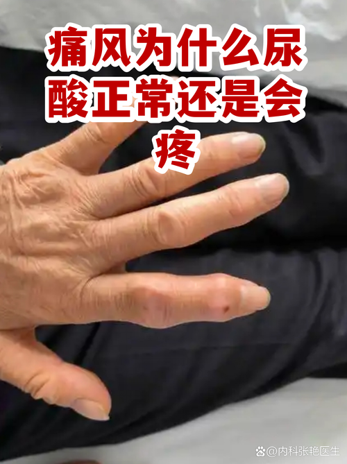 尿酸正常会不会痛风