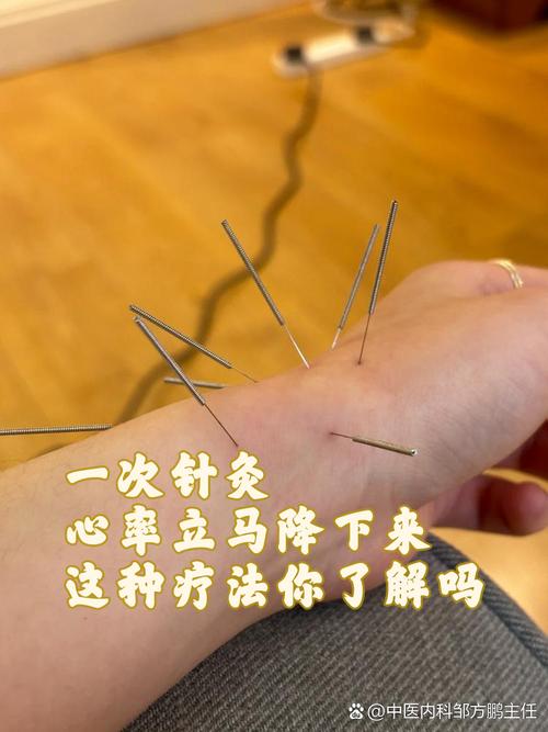 甲亢可以针灸减肥吗