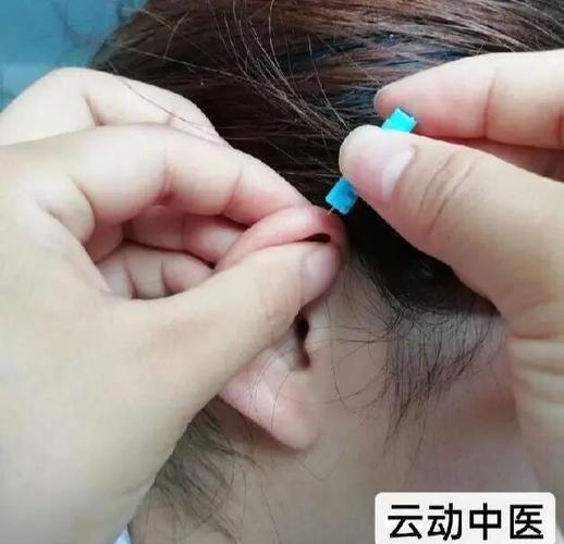 针灸放血疗法治痘痘