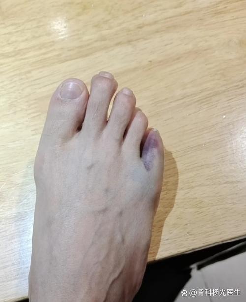 痛风会发生在脚背吗