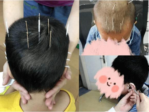 针灸对于脑发育迟缓