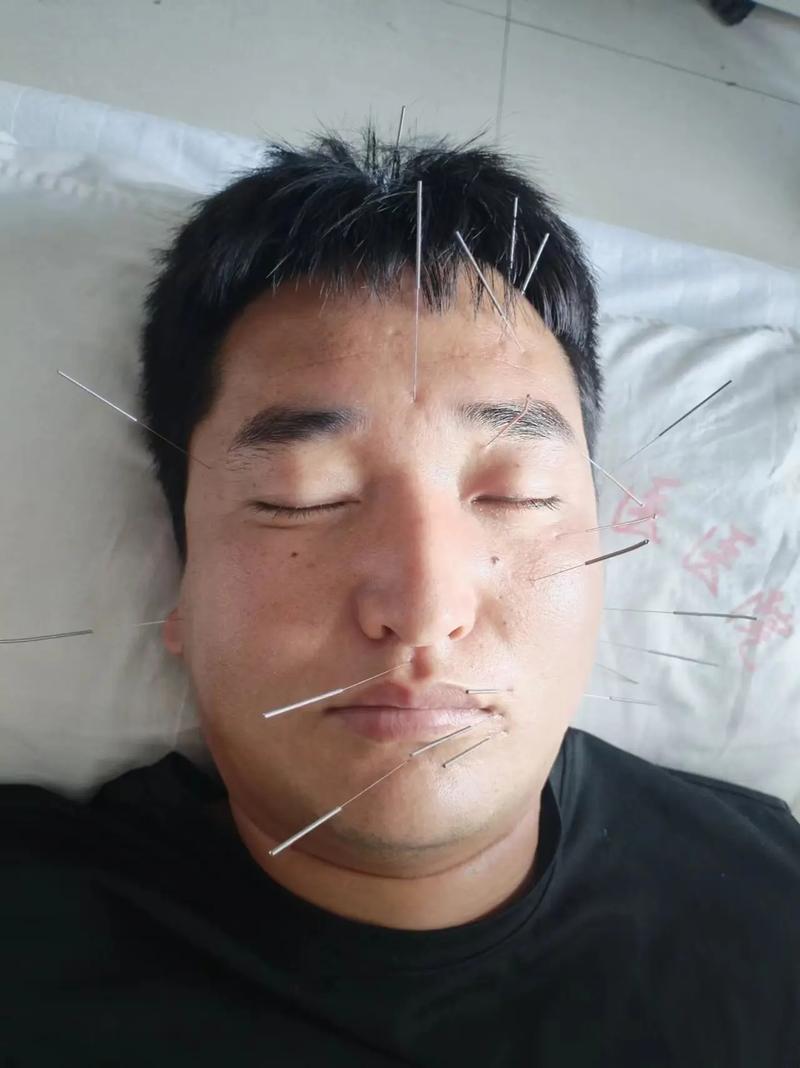 面瘫几天可以扎针灸