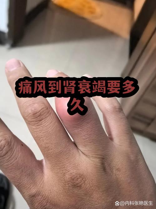 痛风会影响肾功能么