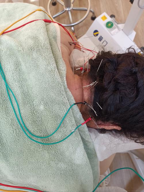 颈椎针灸后感觉疲乏