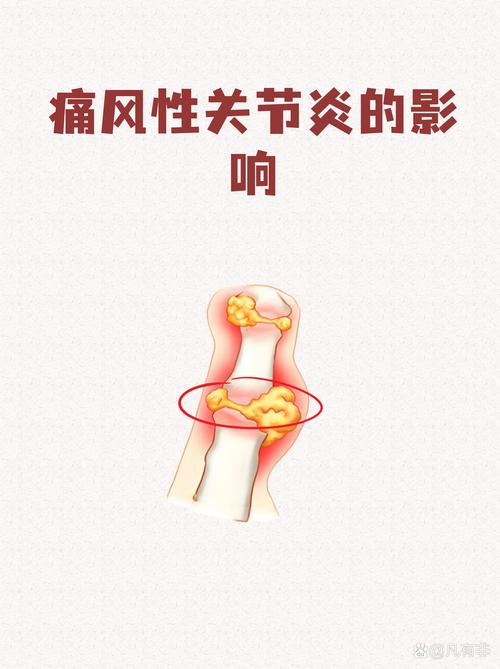 为何德国人不怕痛风